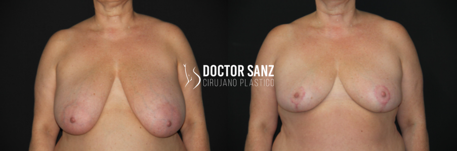 Mamoplastia de reducción 12 01 3