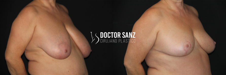 Mamoplastia de reducción 14 03 3