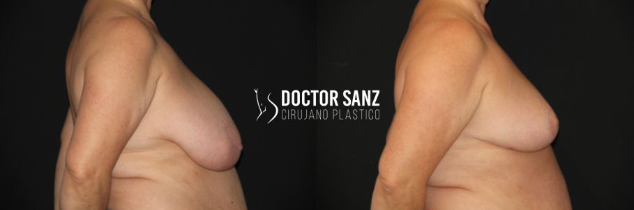 Mamoplastia de reducción 15 04 3