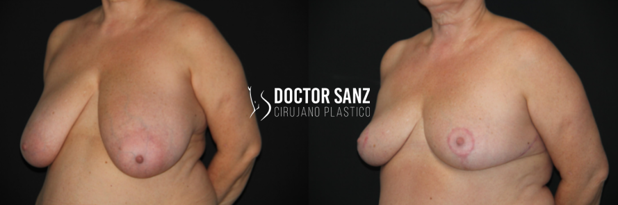 Mamoplastia de reducción 16 05 3