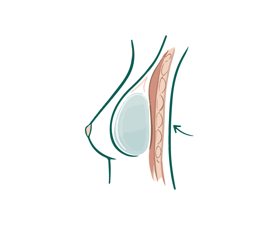 Implante subfascial
