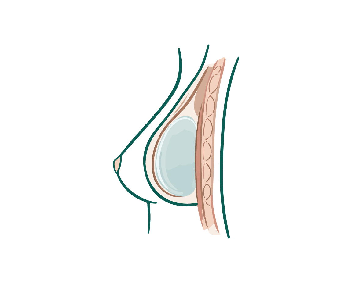 Implante subglandular