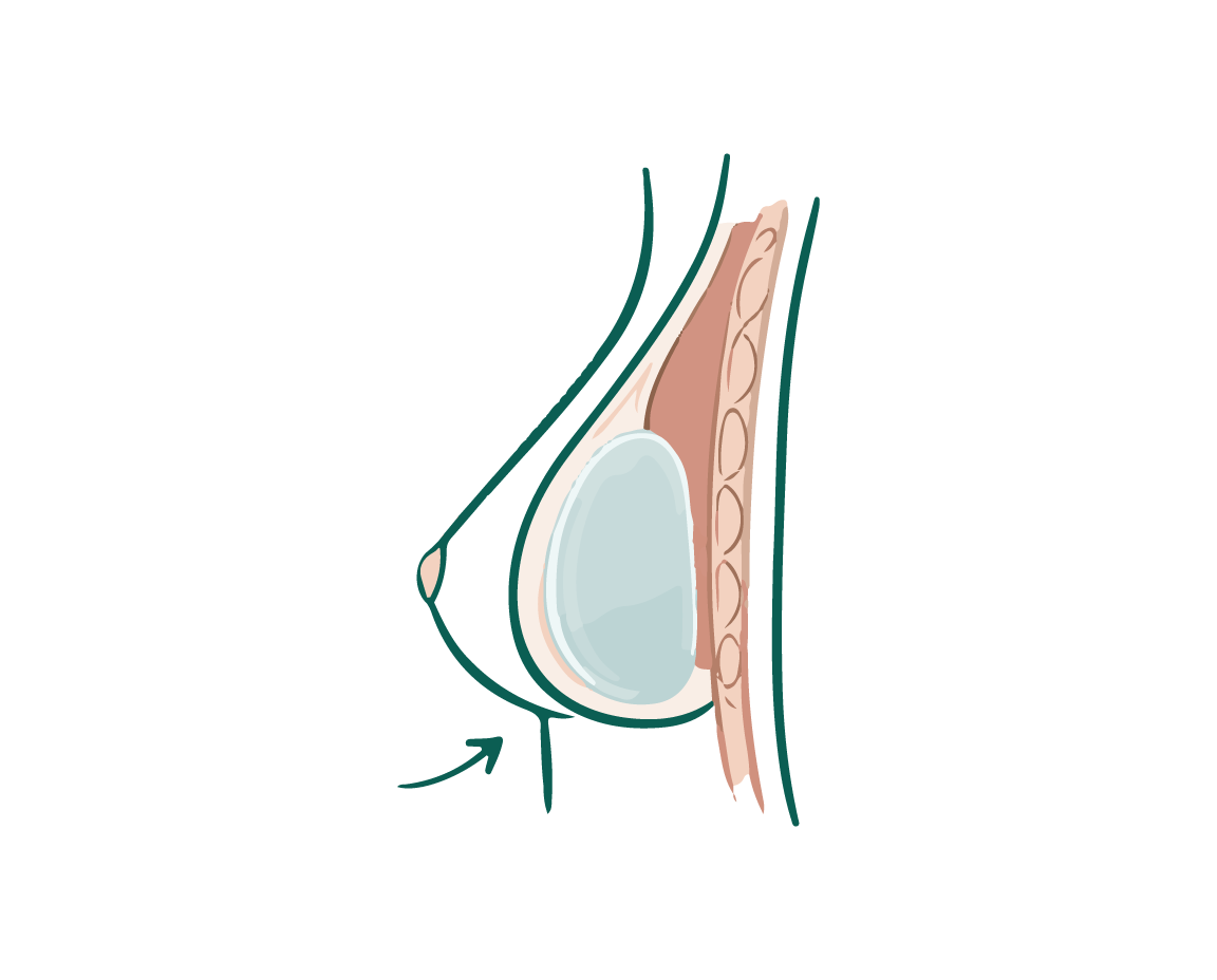 Implante submuscular
