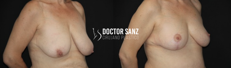 Mamoplastia de reducción 8 02 2