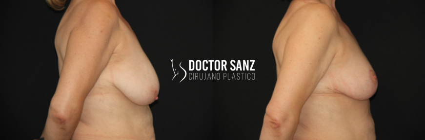 Mamoplastia de reducción 9 03 2
