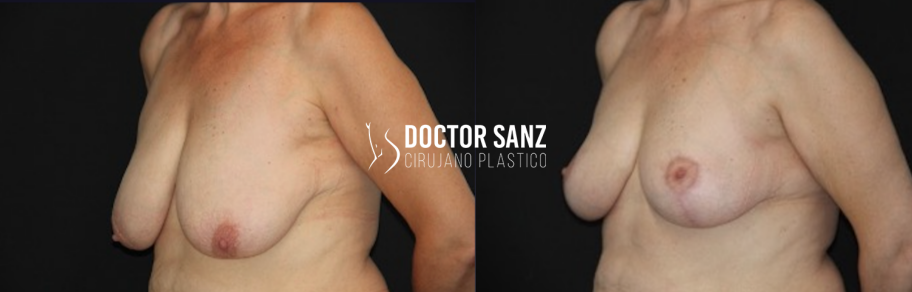 Mamoplastia de reducción 10 04 2
