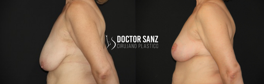 Mamoplastia de reducción 11 05 2
