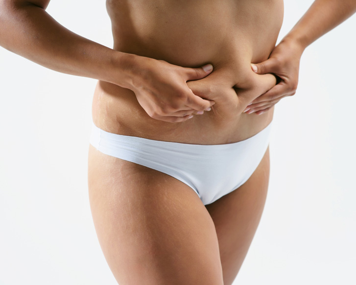 Abdominoplastia