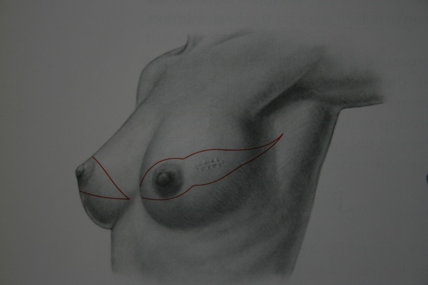 Cirugia Oncologica