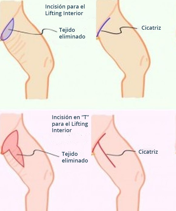 Lifting de muslos 3 LIFTING CRURAL O LIFTING DE MUSLOS CONVENCIONAL