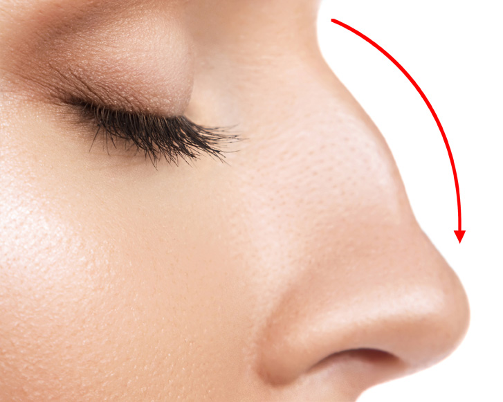 Cirugía Facial 2 Rinoplastia